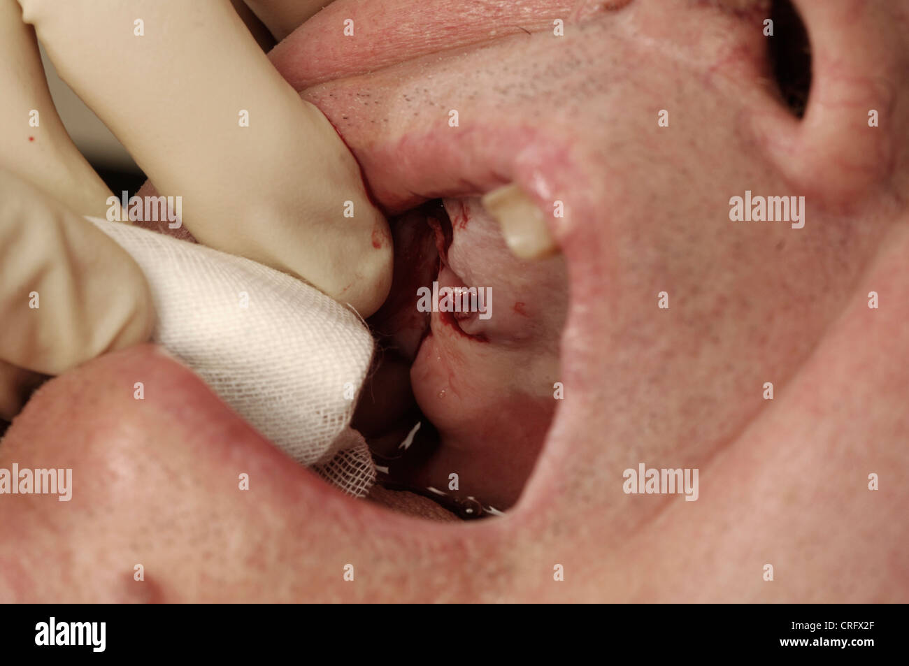 Un dentiste nettoie une purge de la gomme avec une petite gaze après une extraction dentaire. Banque D'Images
