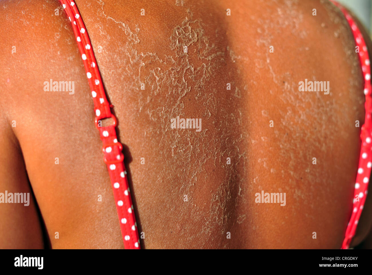 Le soleil endommagé une desquamation de la peau sur les épaules et dos d'une femme portant un bikini. Banque D'Images Le soleil endommagé une desquamation de la peau sur les épaules et dos d'une femme portant un bikini. Banque D'Images