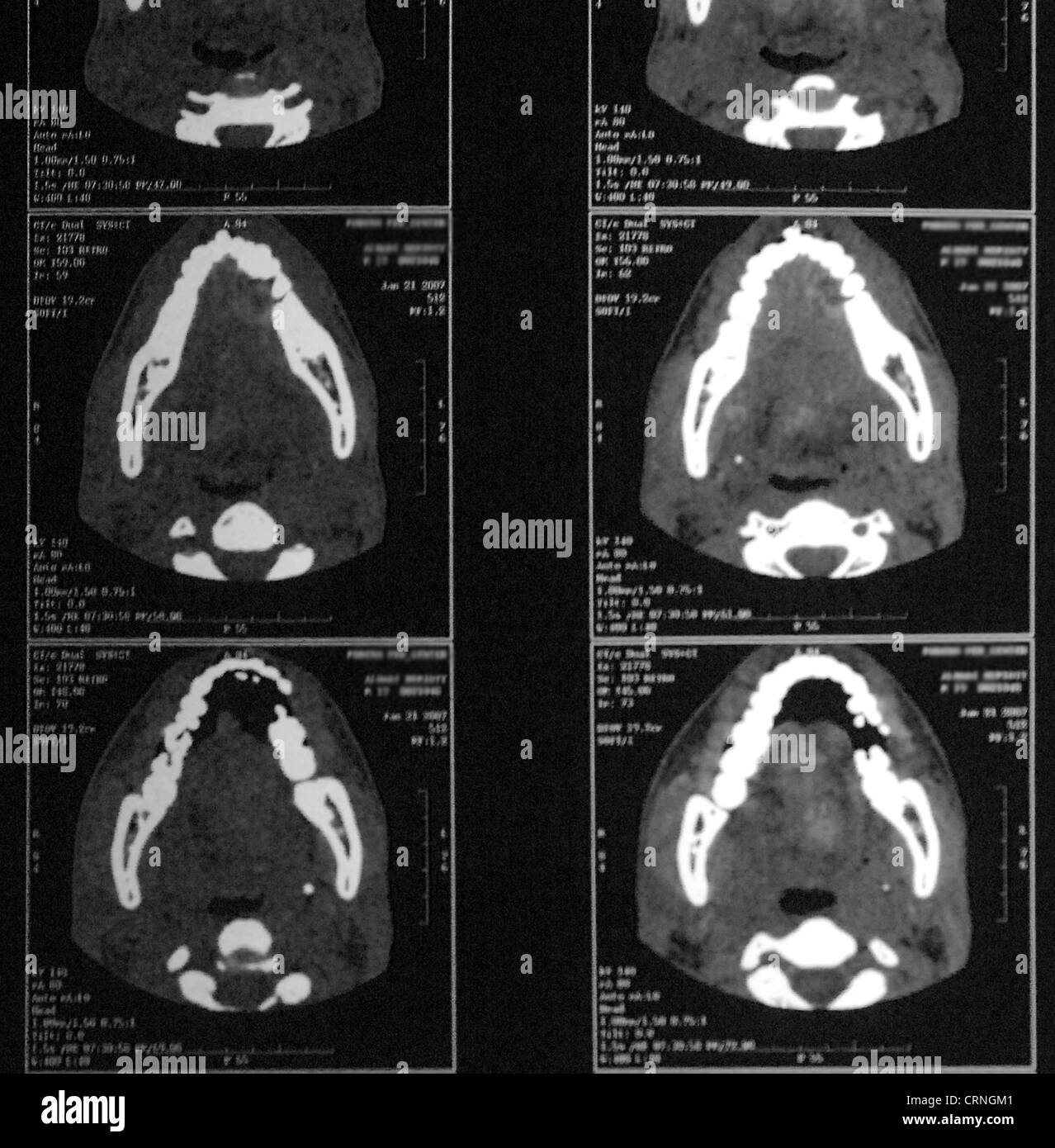 CT scan montrant la muqueuse buccale Eumycetoma dans la bouche du patient. La muqueuse buccale est la muqueuse de l'intérieur de la joue. Eumycetoma est la forme du mycétome fongique ; une maladie de la peau et du tissu conjonctif. Banque D'Images