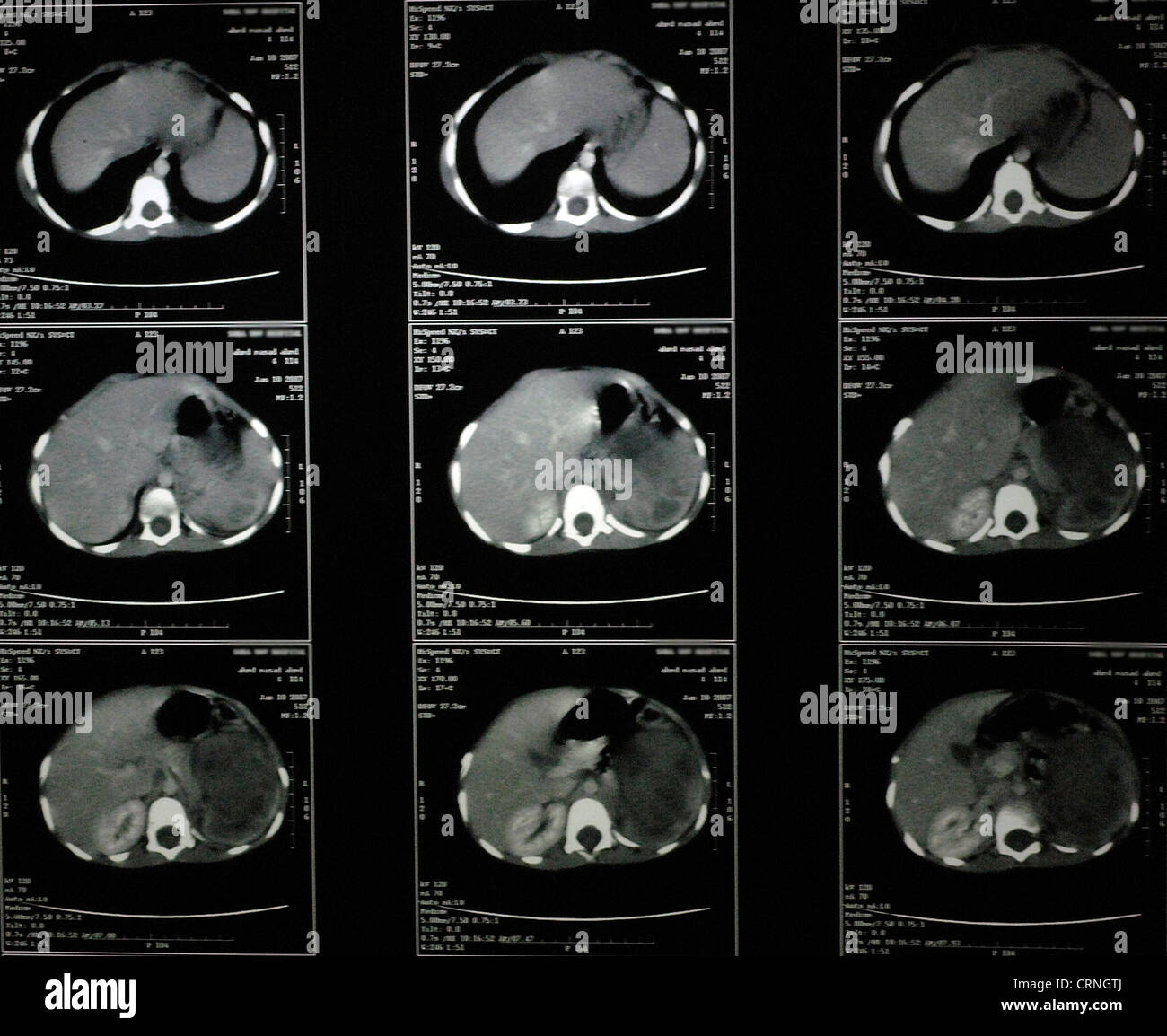 Cat Scan d'une poitrine humaine Banque D'Images
