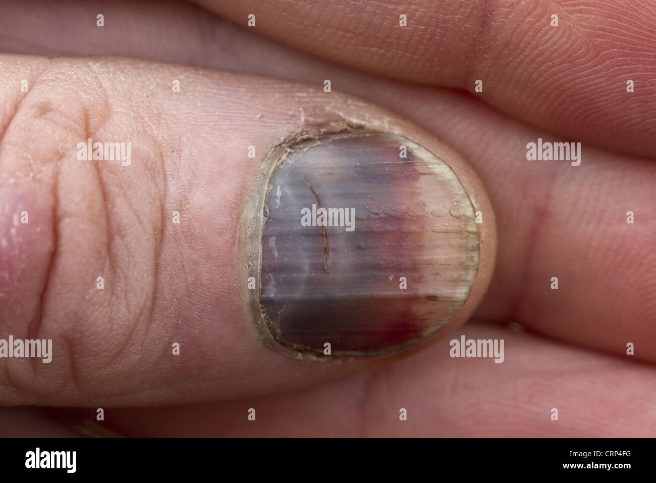 Après un accident d'un ongle c'est noirci. Banque D'Images