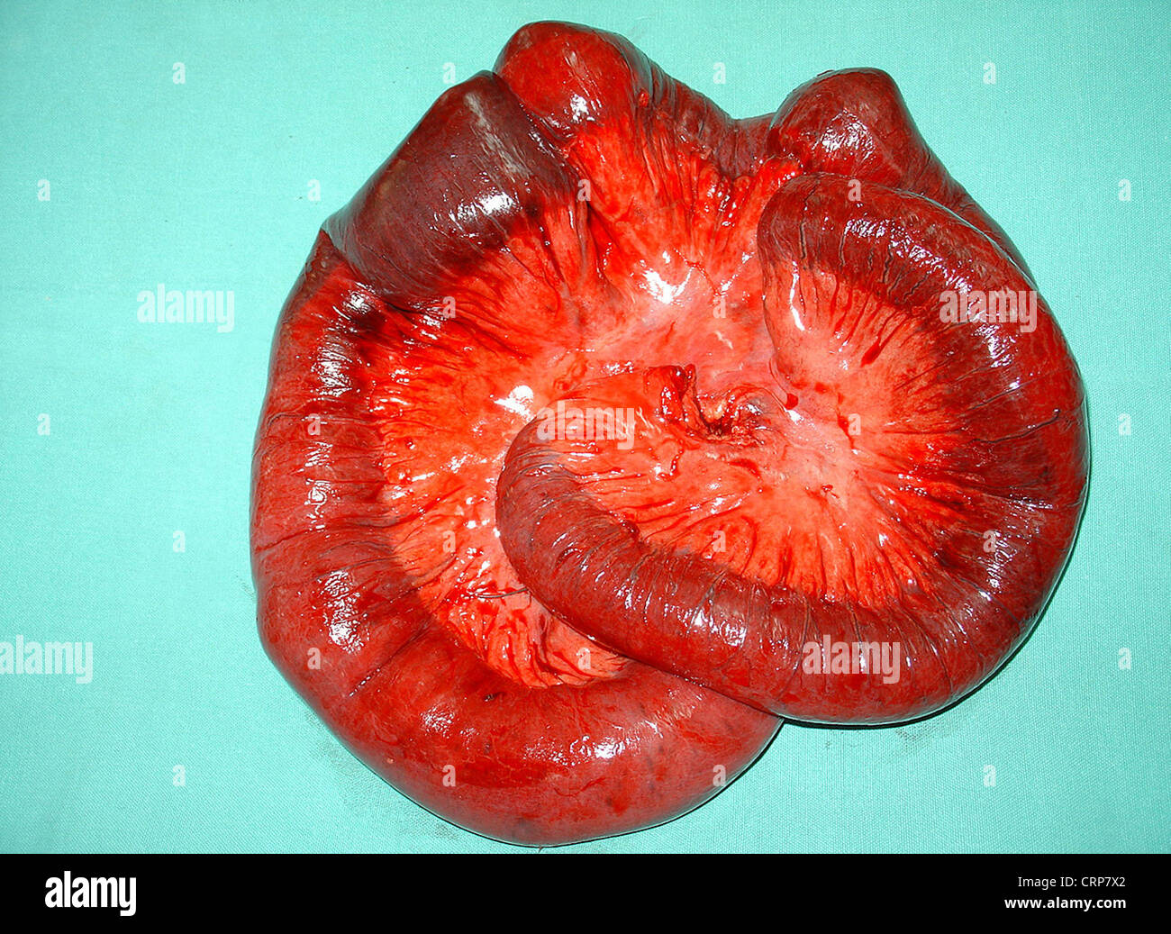 La maladie de l'artère coronaire Banque D'Images