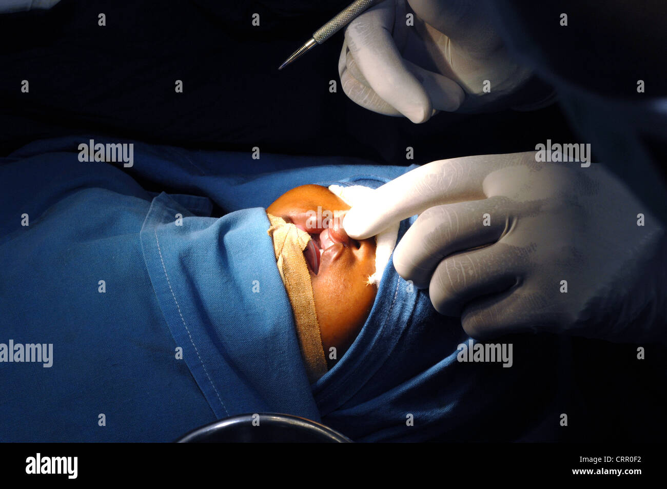 Fente Palatine Bebe Operation Un Deuxieme Fil Est Place Dans La Fente Labiale Repare D Un Enfant Pendant La Chirurgie Photo Stock Alamy