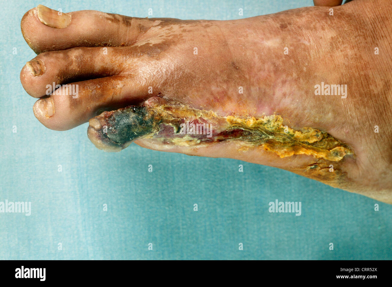 Buerger's disease Banque de photographies et d'images  haute rsolution -  Alamy