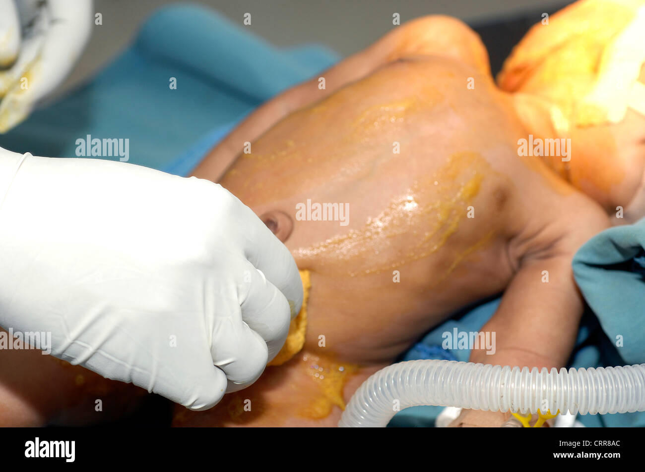 Un corps d'enfant est purifié avec povidone iodée (PVPI) avant la chirurgie. Banque D'Images