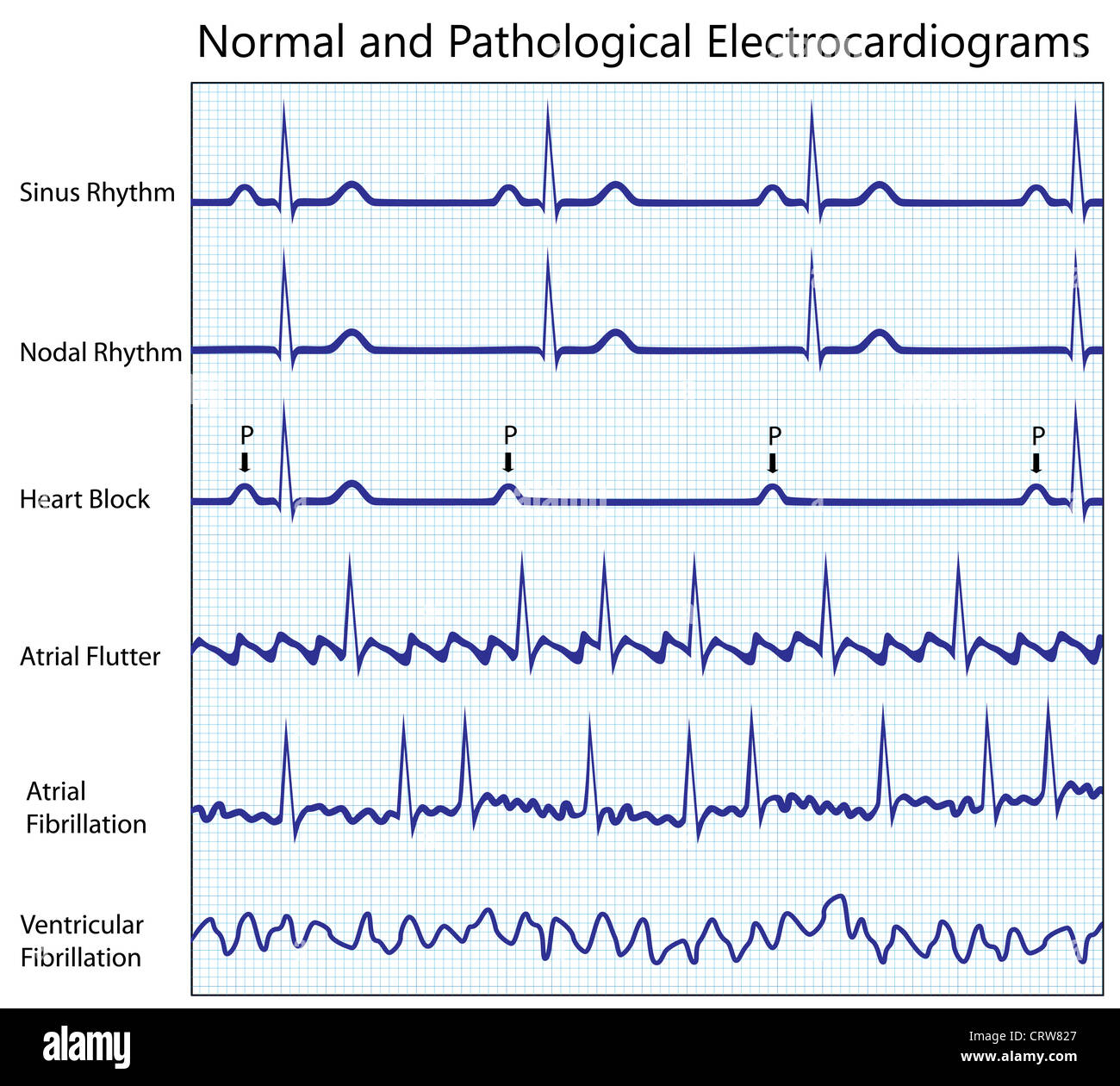 Collection ecg normaux et malades Banque D'Images