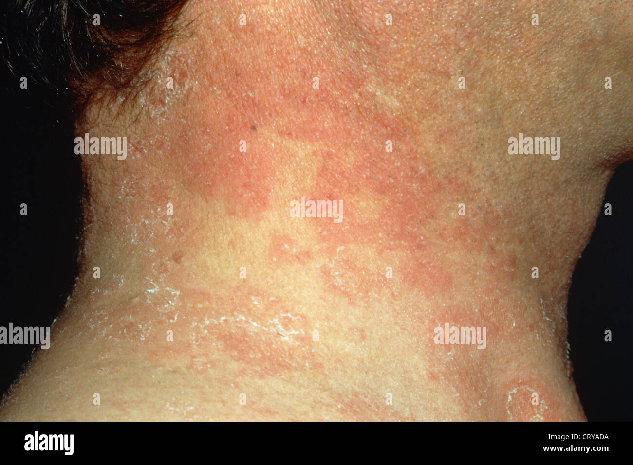 La dermatite séborrhéique Banque D'Images