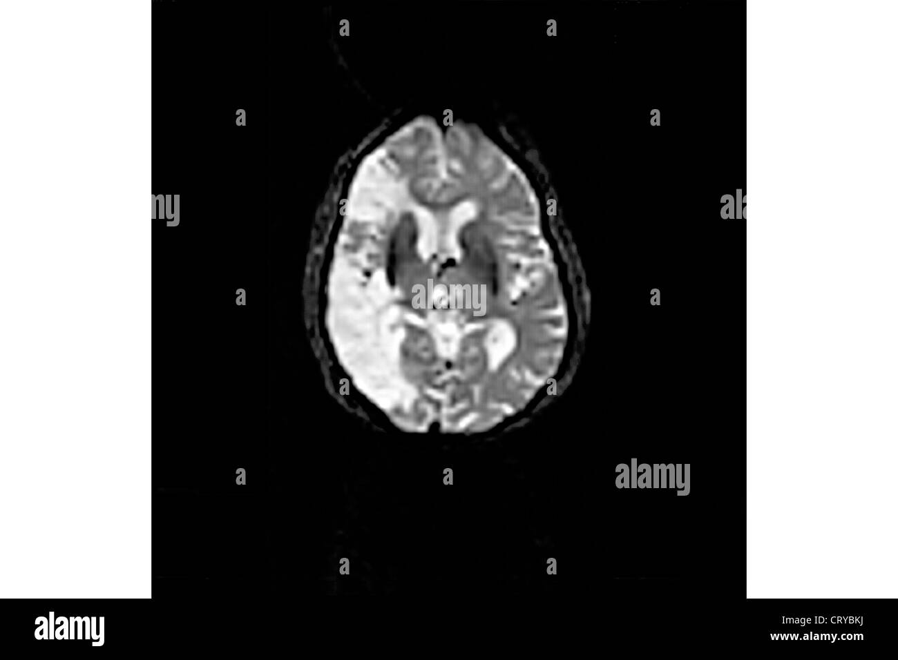 Les maladies cérébrovasculaires, IRM Banque D'Images