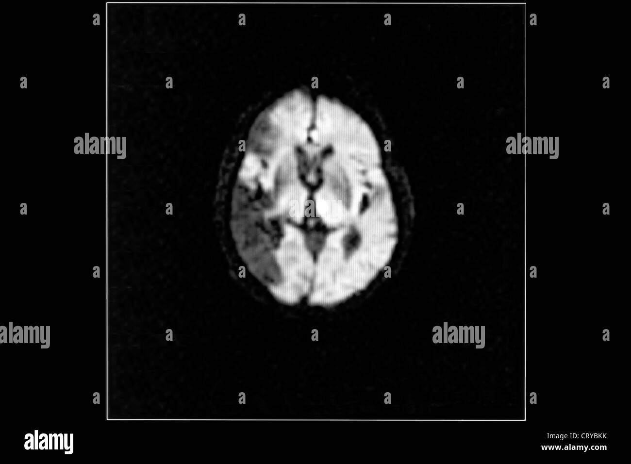 Les maladies cérébrovasculaires, IRM Banque D'Images