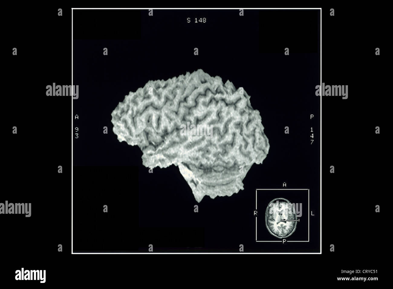 CORTEX CÉRÉBRAL, IRM Banque D'Images