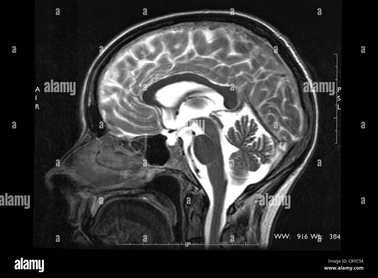 IRM CÉRÉBRALE, Banque D'Images