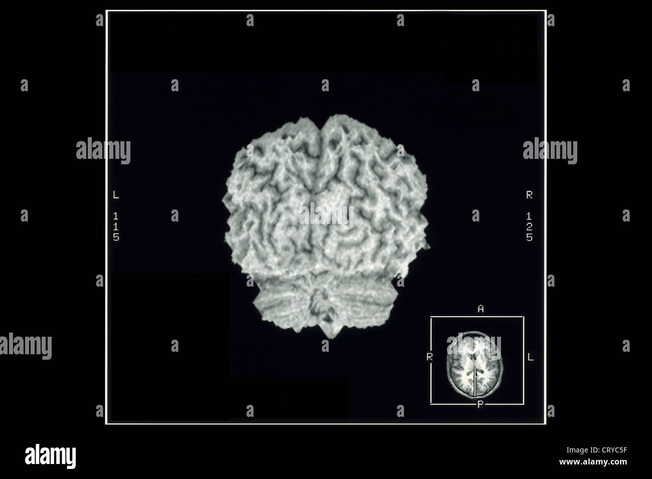 CORTEX CÉRÉBRAL, IRM Banque D'Images