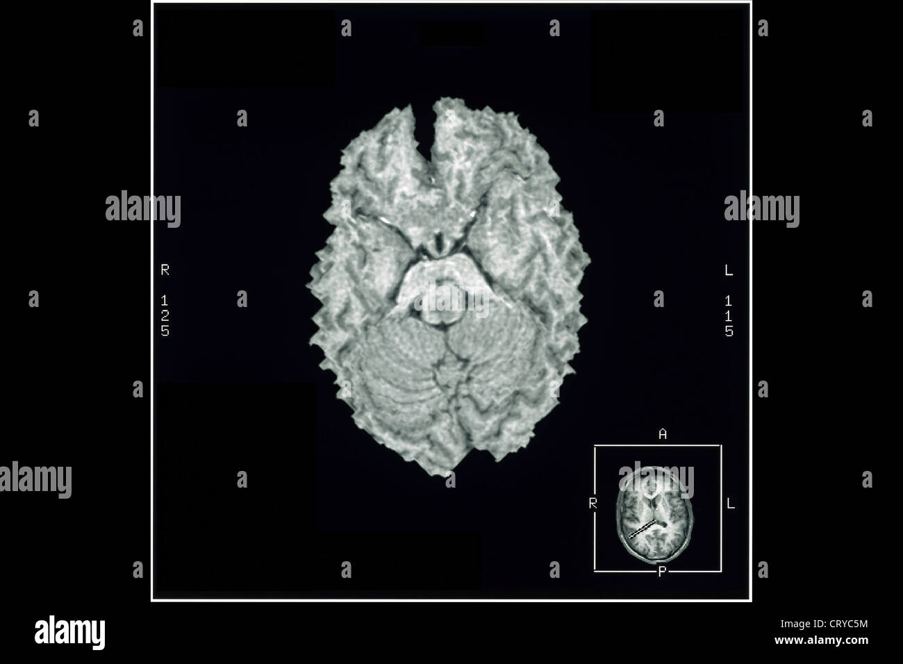 CORTEX CÉRÉBRAL, IRM Banque D'Images