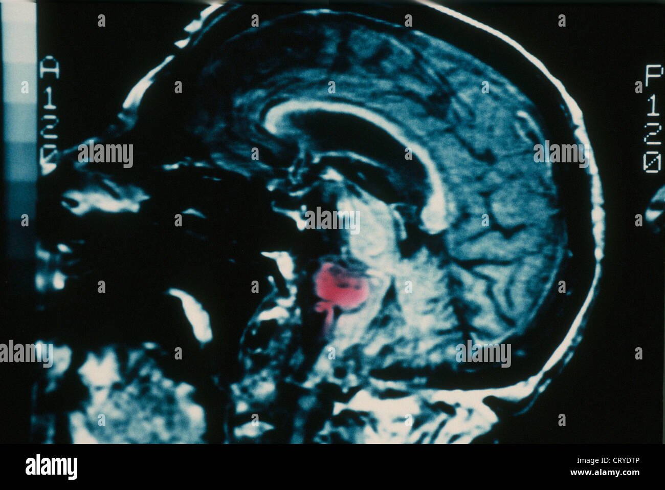 Le cerveau de l'anévrisme, IRM Photo Stock - Alamy