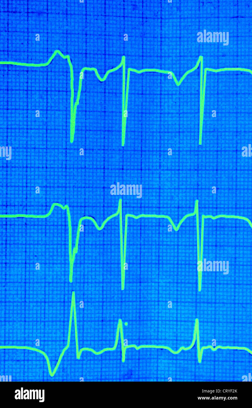 EXTRASYSTOLE, ECG Banque D'Images