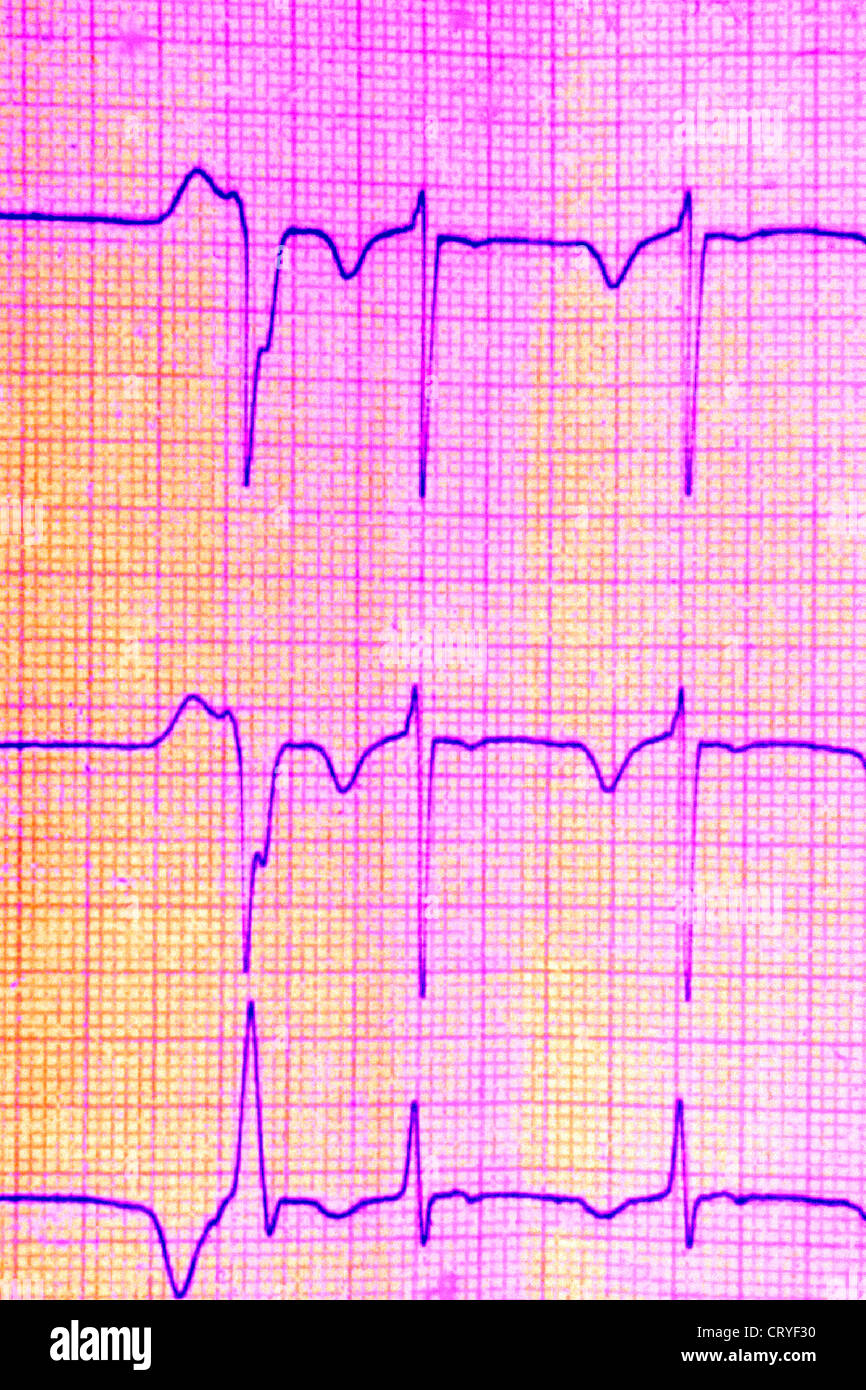 EXTRASYSTOLE, ECG Banque D'Images