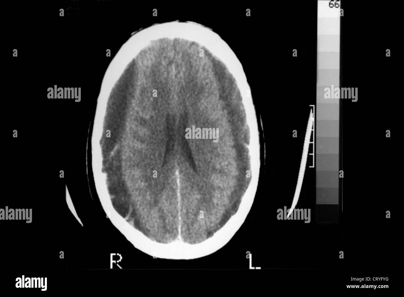 L'hématome, BRAIN SCAN Banque D'Images