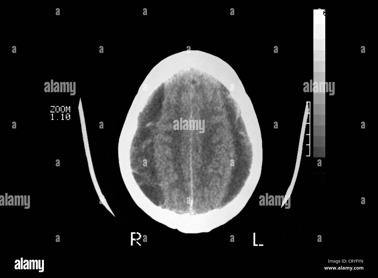 L'hématome, BRAIN SCAN Banque D'Images