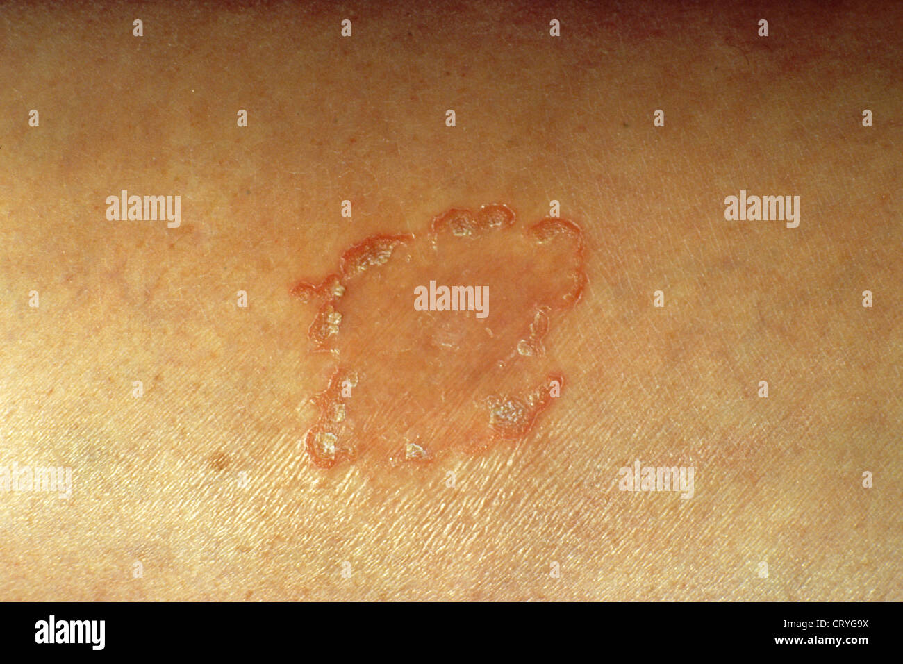 La dermatite séborrhéique Banque D'Images