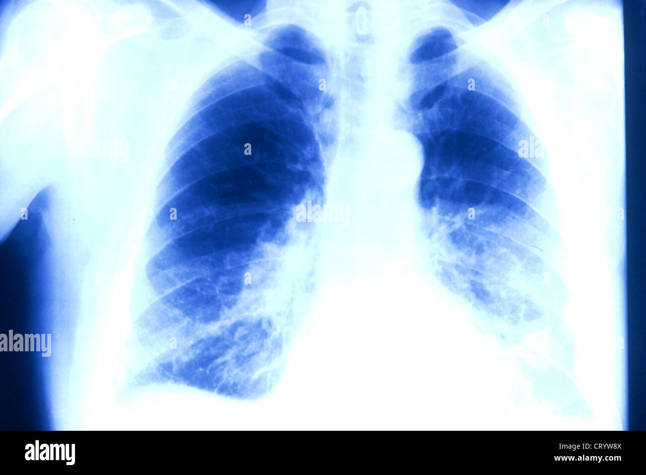L'embolie pulmonaire, X-RAY Photo Stock - Alamy
