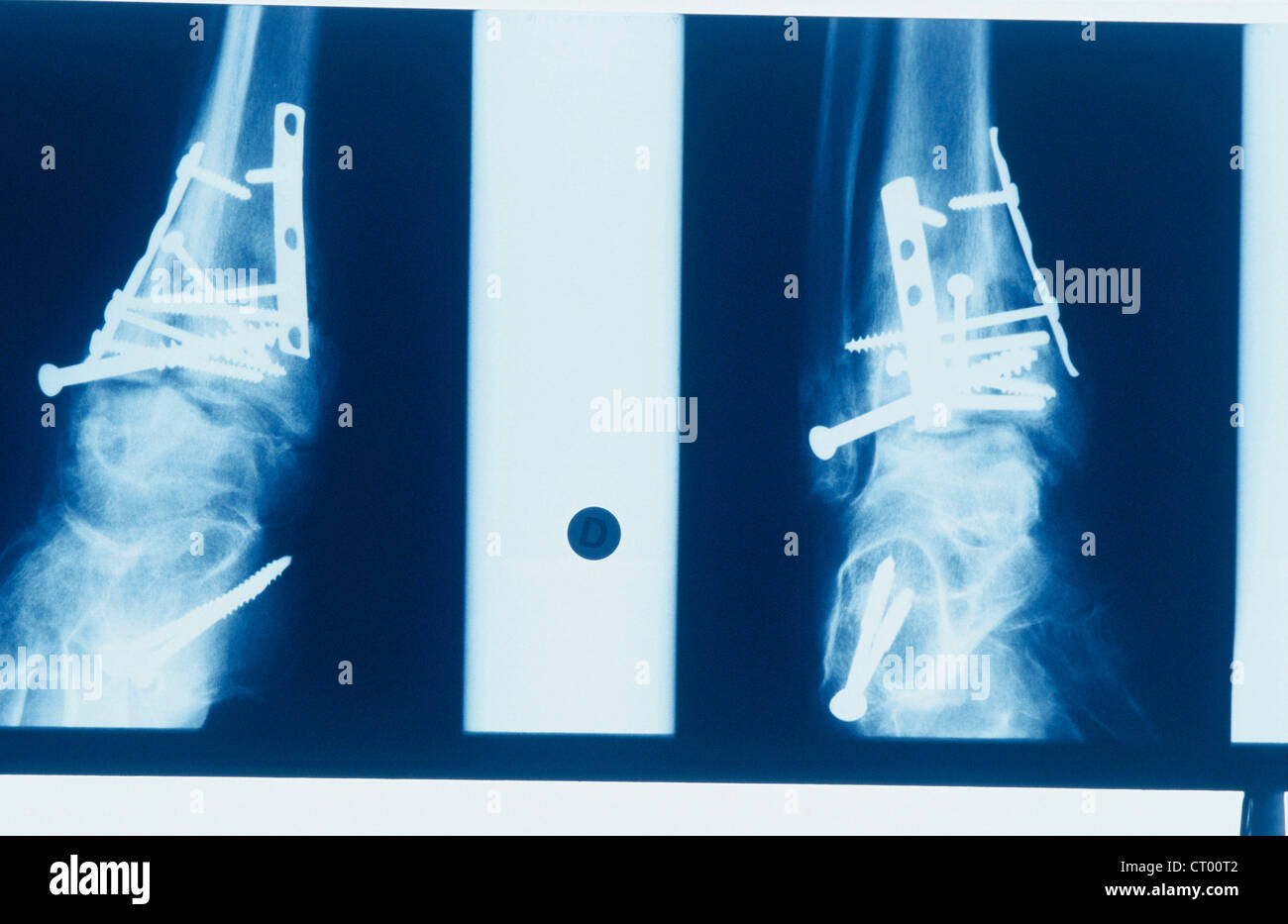 L'ostéosynthèse de la cheville, X-RAY Photo Stock - Alamy