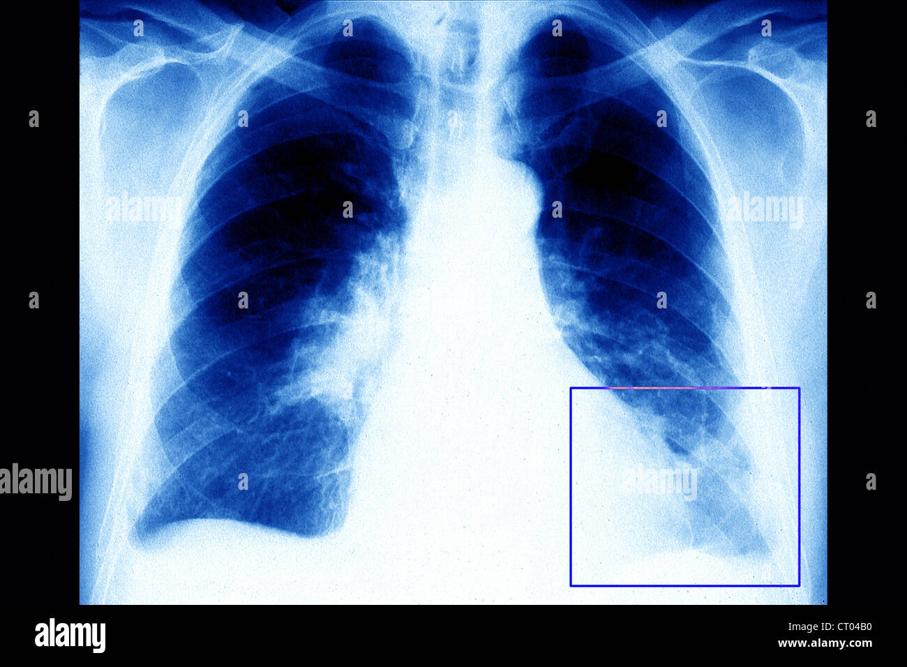 L'EMBOLIE PULMONAIRE RADIO Banque D'Images