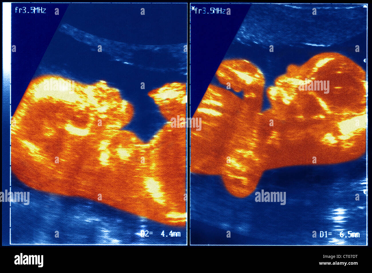 La Nouvelle Vie Des Jumeaux Scan Vf Obstetrical ultrasound scan jumeau Banque de photographies et d’images