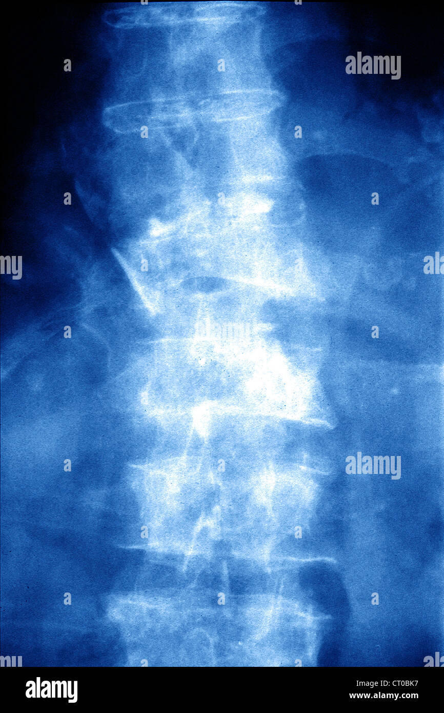 FRACTURE par tassement, IRM Banque D'Images