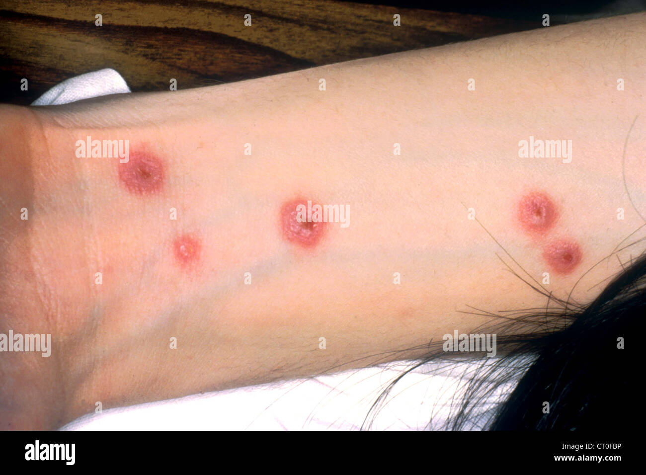 Syndrome de stevens johnson Banque de photographies et d’images à haute