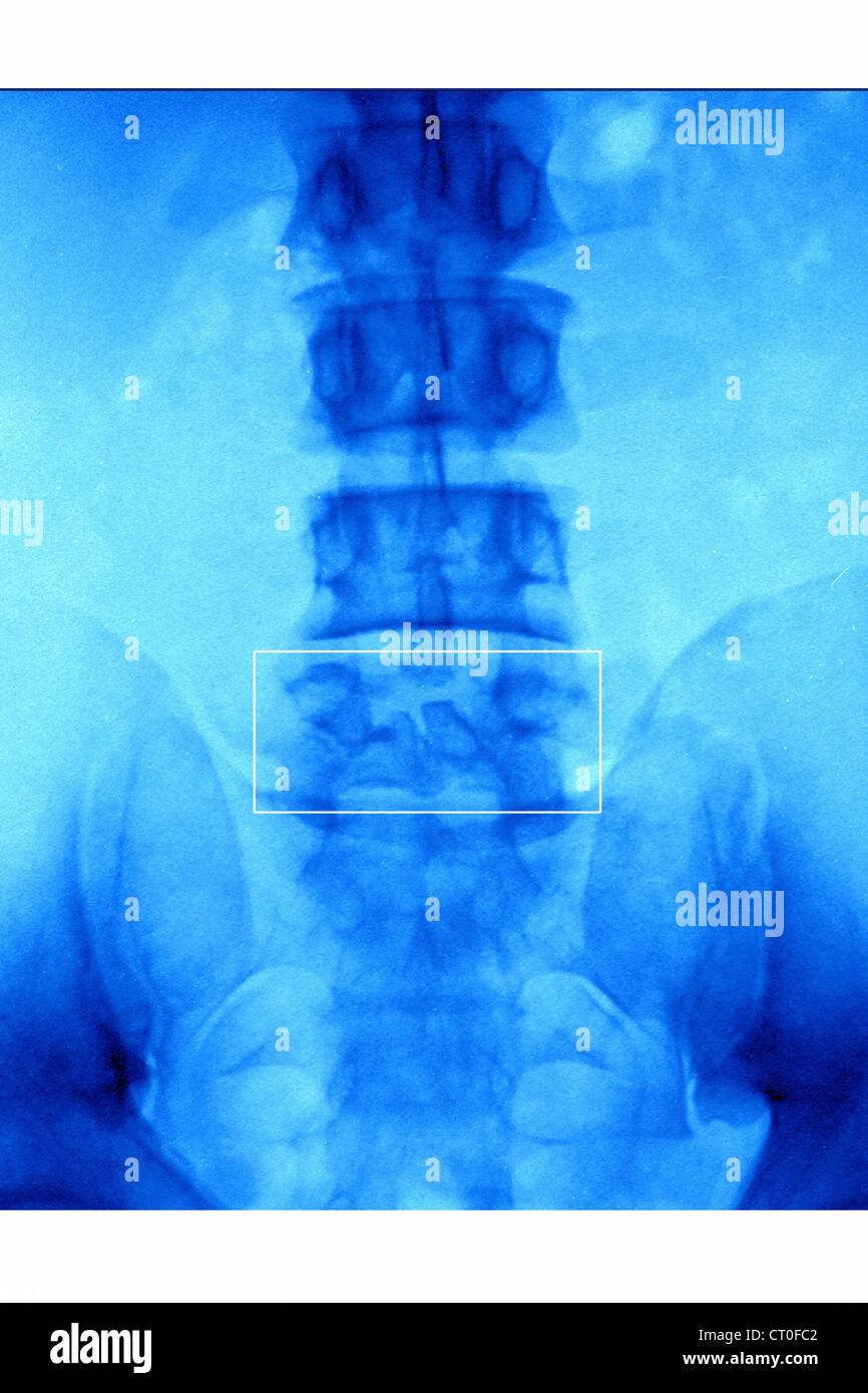 FRACTURE par tassement, X-RAY Banque D'Images