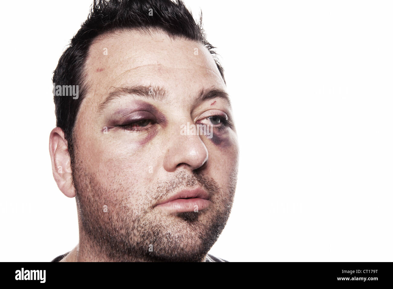 Blessure à l'œil, homme avec oeil noir isolé sur blanc. homme après accident ou lutte avec ecchymose Banque D'Images