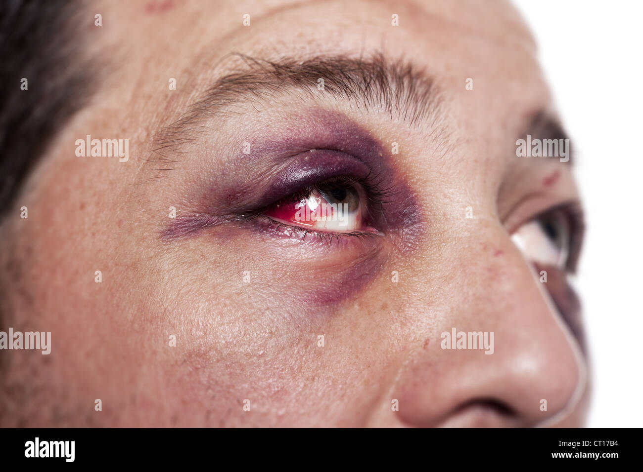 Blessure à l'œil, homme avec oeil noir isolé sur blanc. homme après accident ou lutte avec ecchymose Banque D'Images