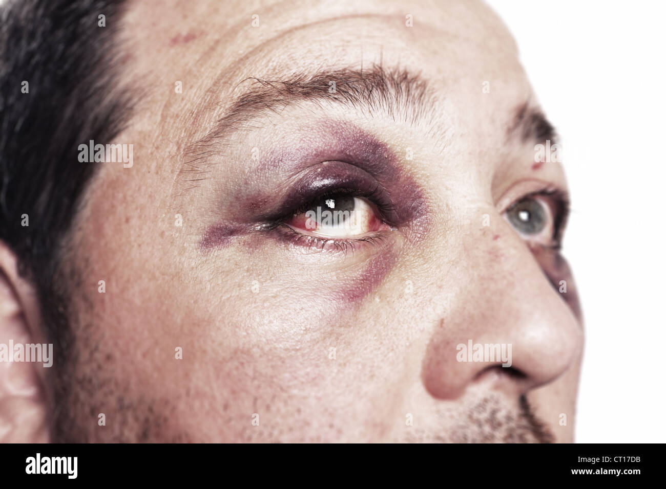 Blessure à l'œil, homme avec oeil noir isolé sur blanc. homme après accident ou lutte avec ecchymose Banque D'Images