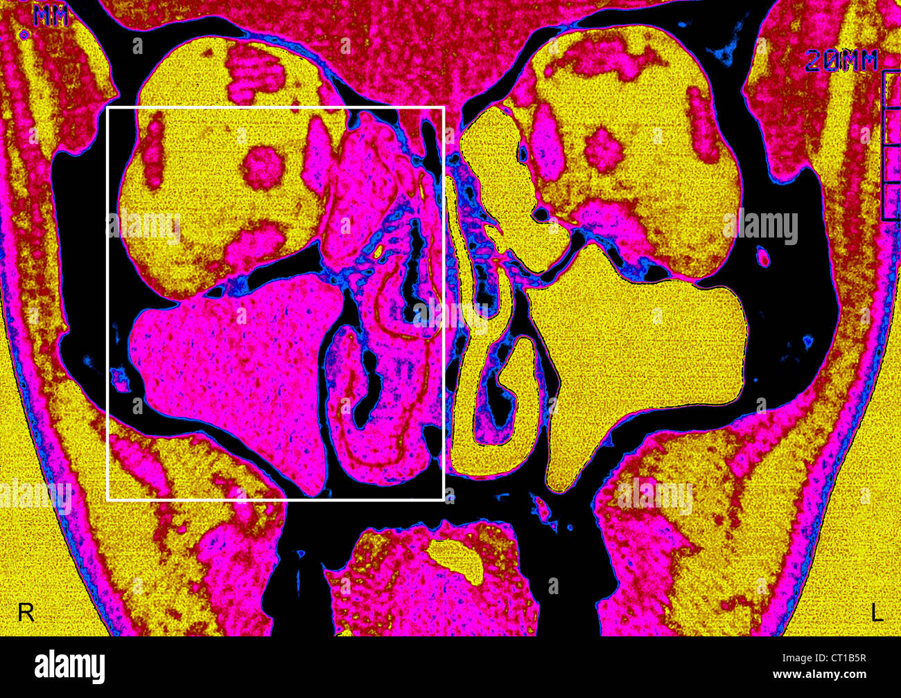 SINUSITE, SCAN Banque D'Images