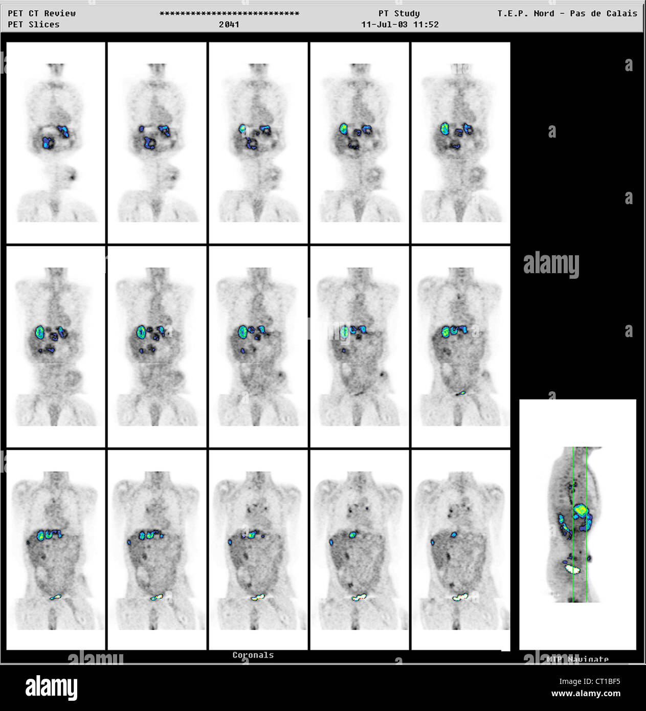 Le carcinome rectal Banque D'Images