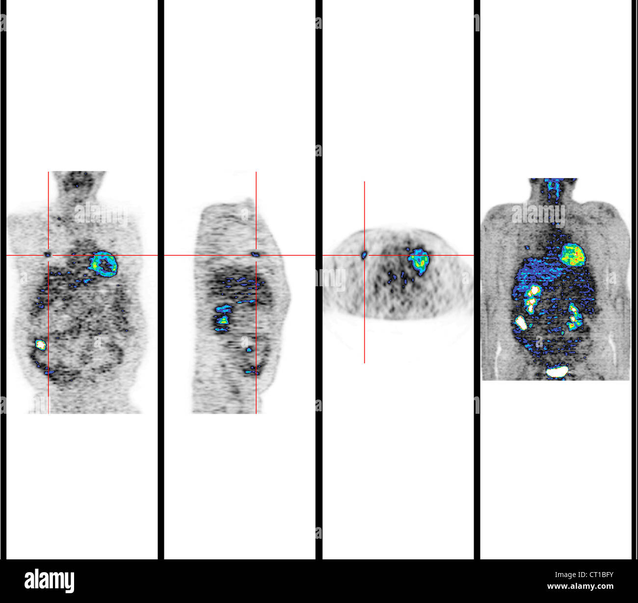 L'ADÉNOCARCINOME DE COLON Banque D'Images