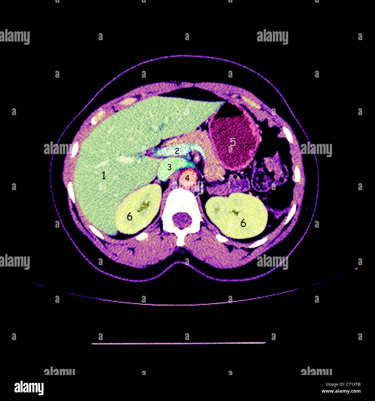 ABDOMEN, SCAN Banque D'Images