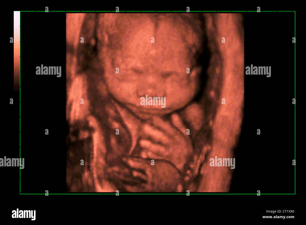 3 Months Fetus Banque D Image Et Photos Page 2 Alamy