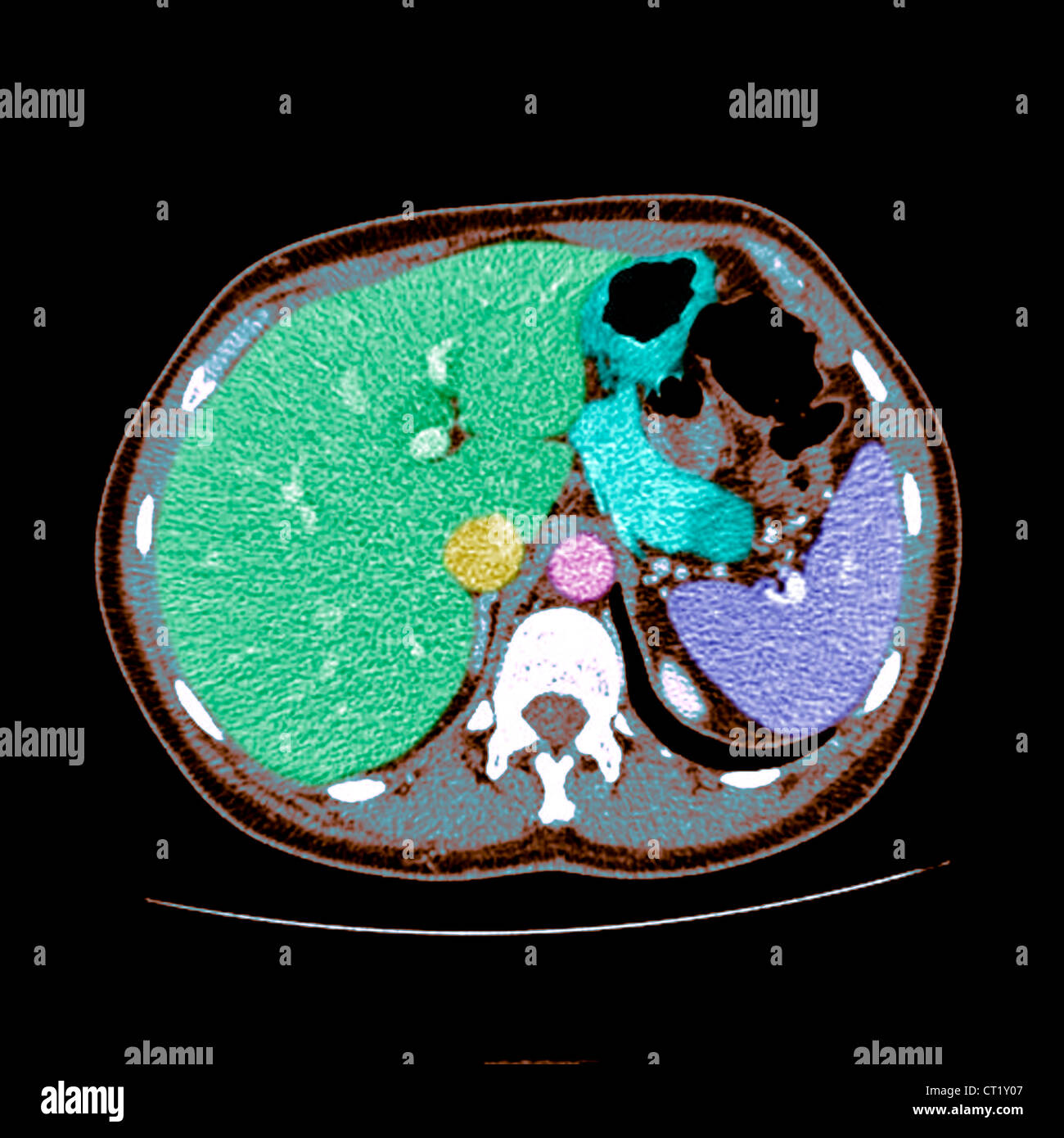 ABDOMEN, SCAN Banque D'Images