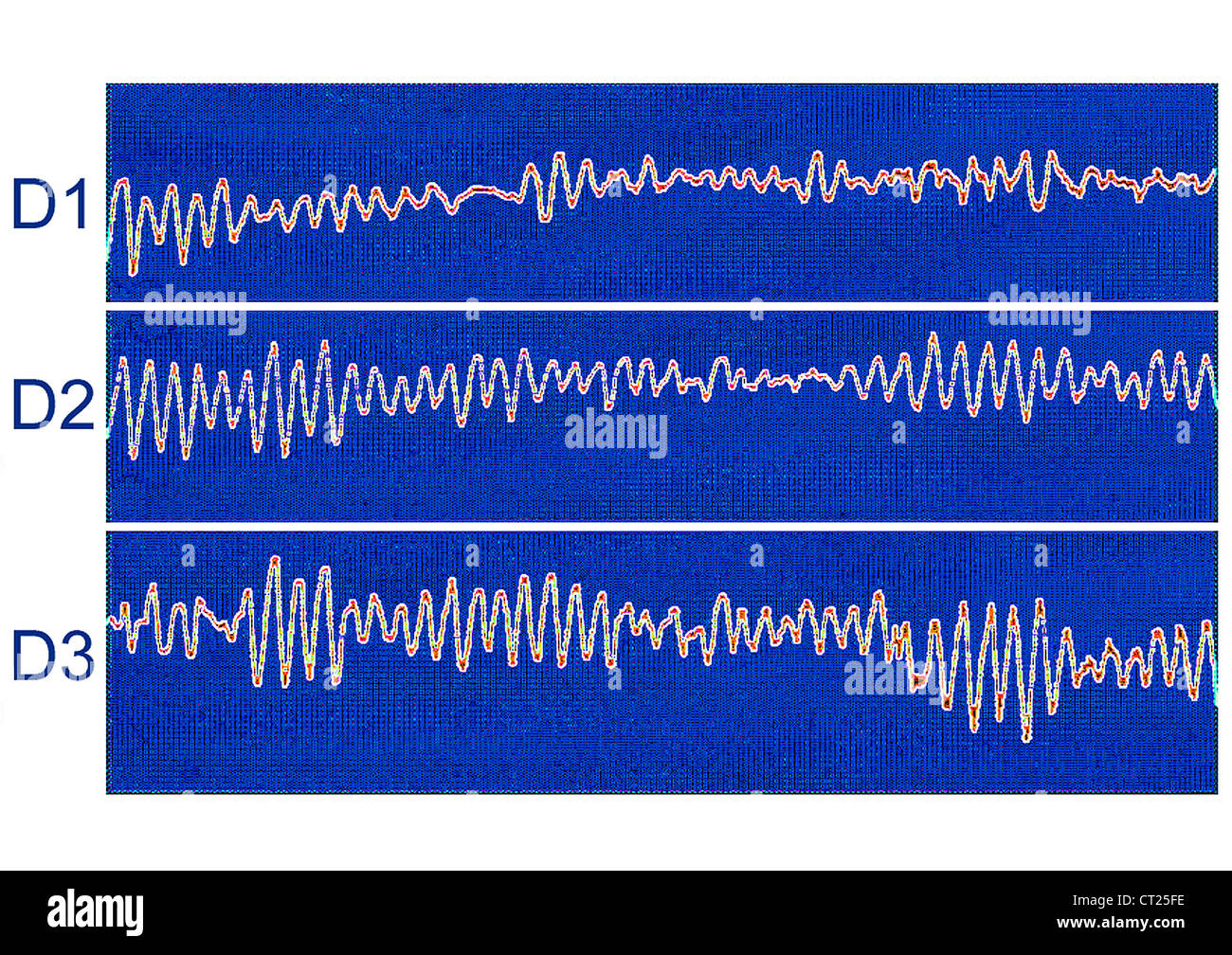 La fibrillation ventriculaire, ECG Photo Stock Alamy