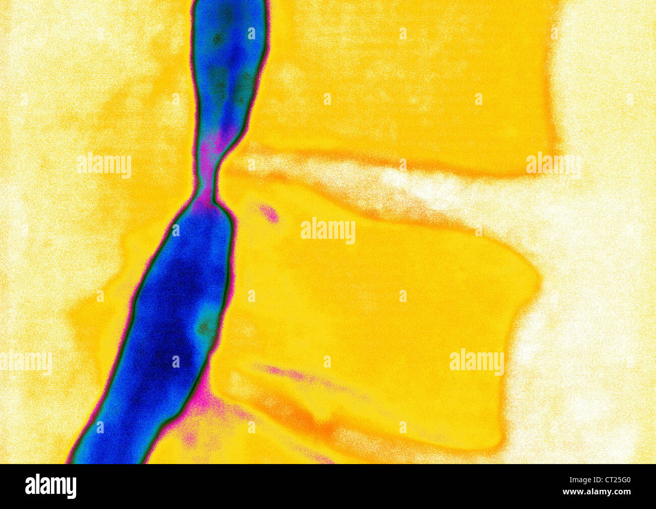 La hernie discale, X-RAY Banque D'Images