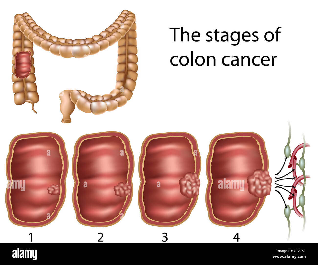 Cancer du côlon Photo Stock Alamy