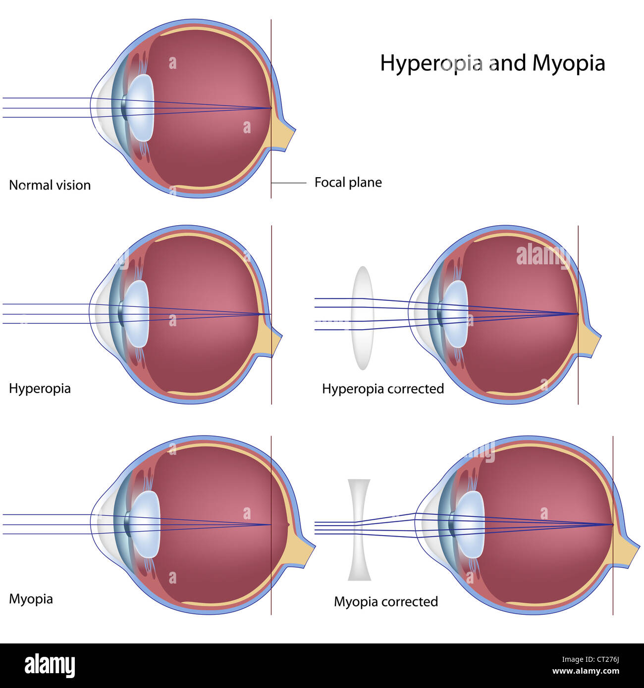 Myopie et hypermétropie Banque D'Images