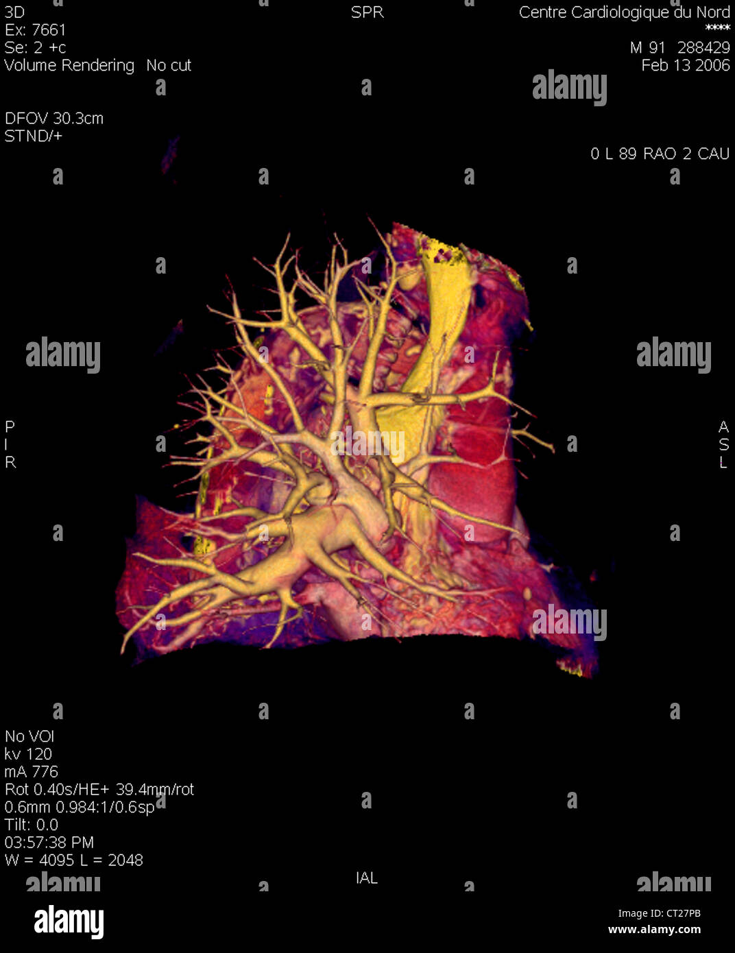 Vascularisation pulmonaire Banque de photographies et d’images à haute — free download