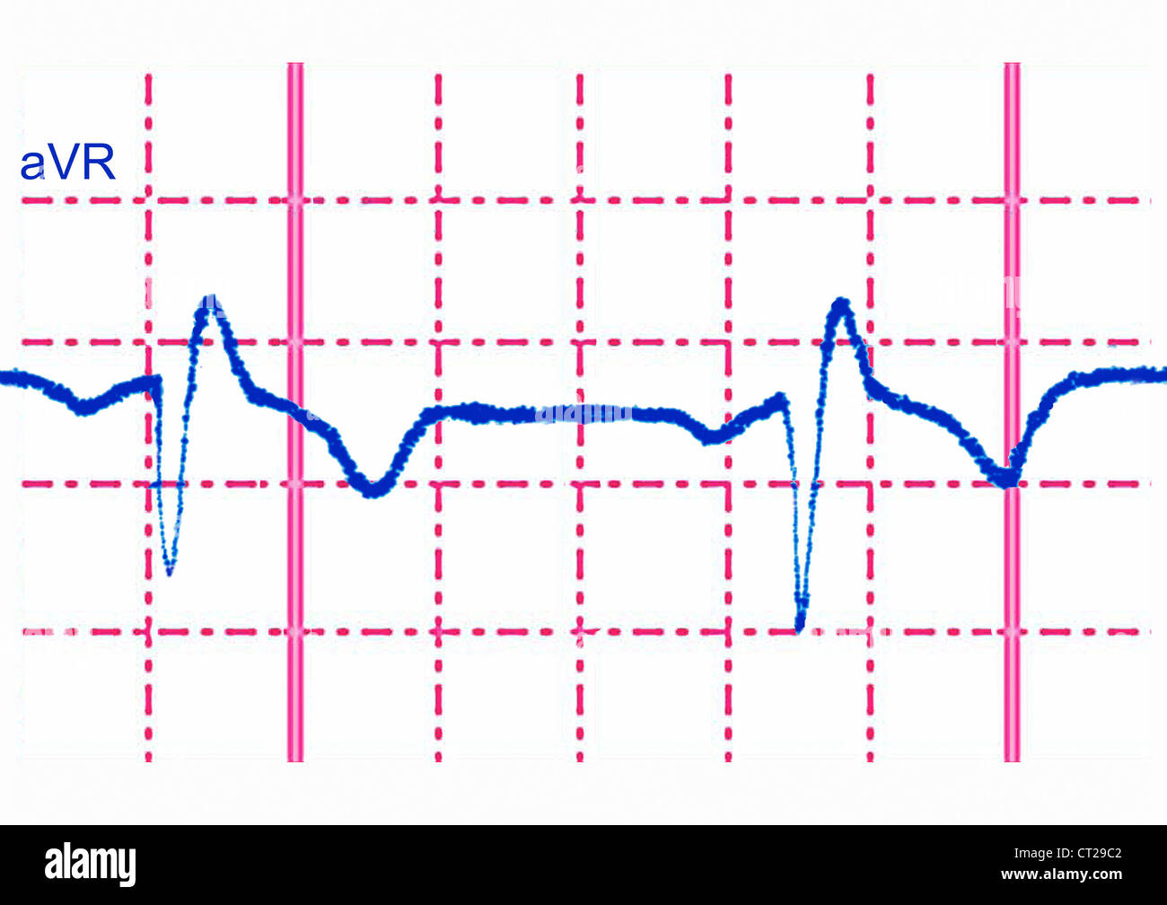 Bloc de branche droit, ECG Banque D'Images