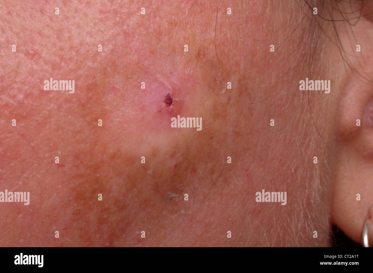 La kératose actinique Photo Stock Alamy