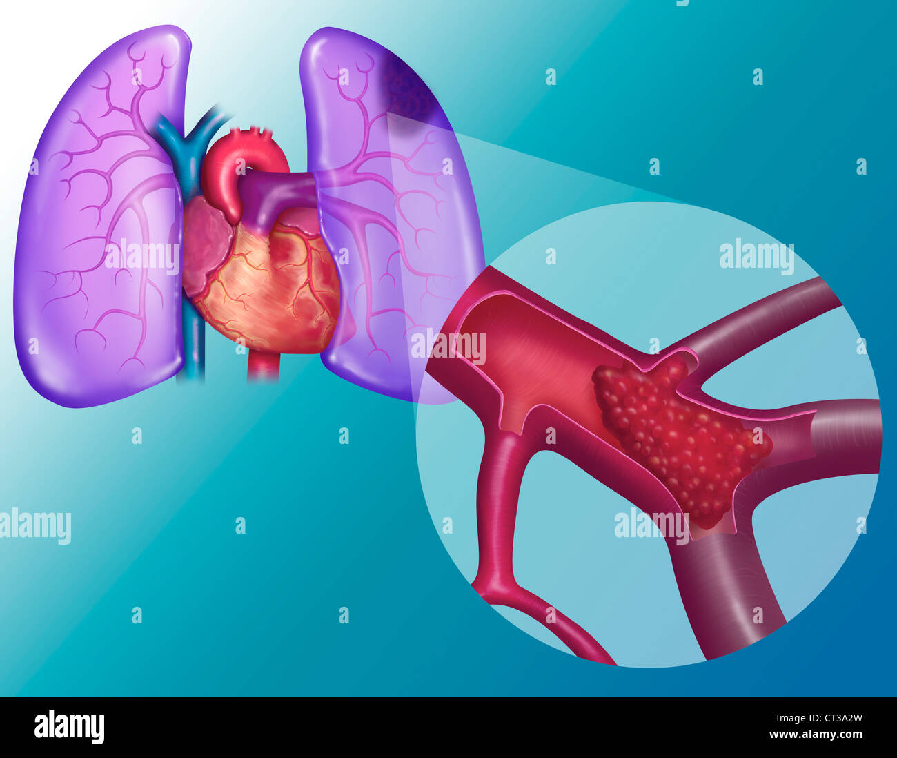 L'embolie pulmonaire, dessin Banque D'Images