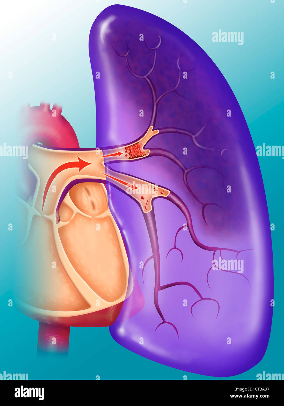 L'embolie pulmonaire, dessin Banque D'Images
