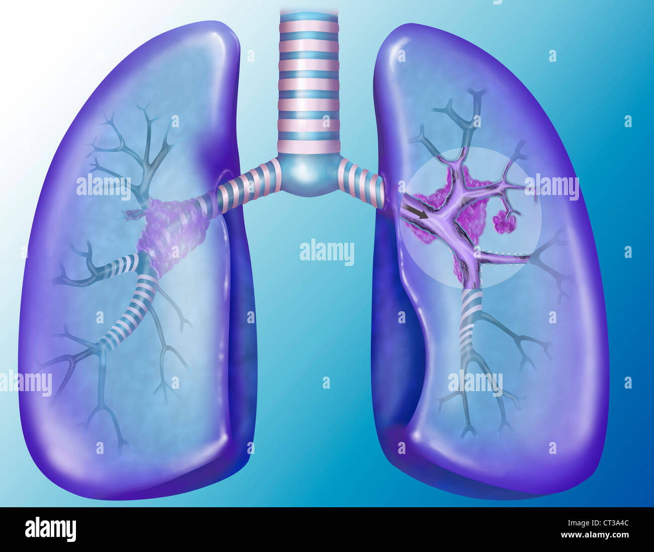 Le CANCER DU POUMON, dessin Banque D'Images