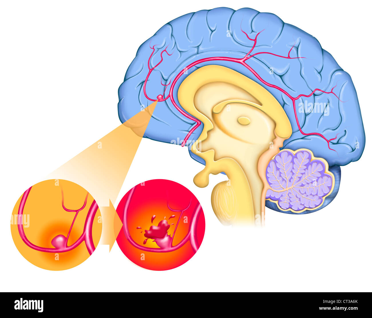 Anévrisme CERVICAL Banque D'Images